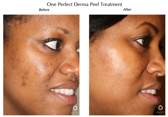 Before & After chemical peels