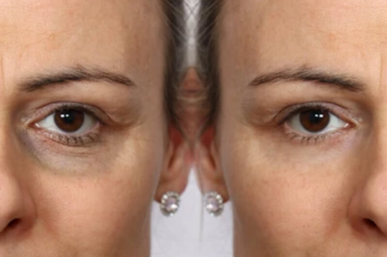 Skinsations PRP Face lift Treatment