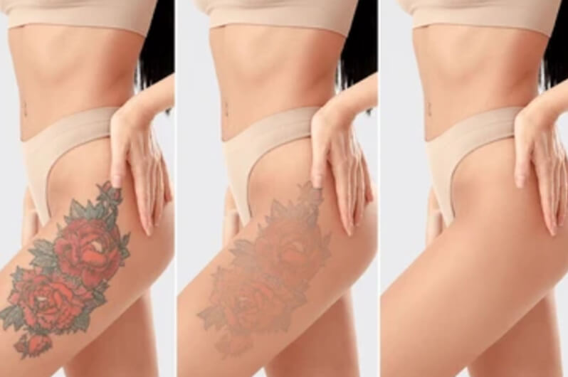 Skinsations Tattoo Removal